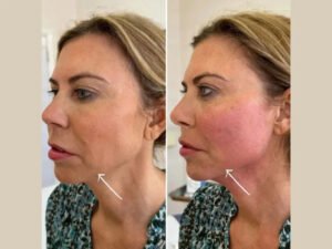 Best Aesthetic Clinics in dubai for Endolift Youthful-Looking Skin