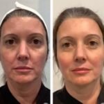 Best Aesthetic Clinic in Dubai Delivering High Quality Thread Lift Experiences