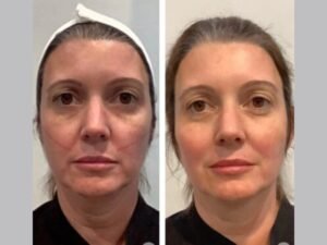 Best Aesthetic Clinic in Dubai Delivering High Quality Thread Lift Experiences