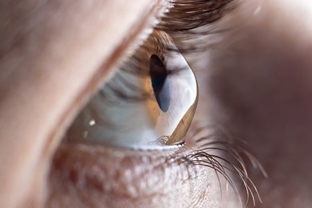 LASIK Eye Surgery London (2)