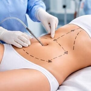 Liposuction in Dubai