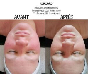 Épilation IPL à Saint-Georges Québec