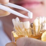 Dental Aligners Cost: Pricing, Benefits & Treatment Process