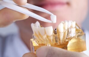 Dental Aligners Cost: Pricing, Benefits & Treatment Process