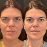 Best Doctors in Dubai Offering Effective Thread Lift for Facial Rejuvenation