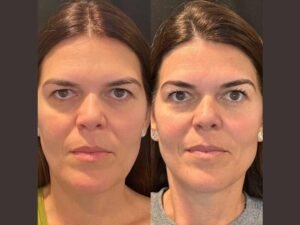 Best Doctors in Dubai Offering Effective Thread Lift for Facial Rejuvenation