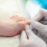 nail surgery for ingrown toenails