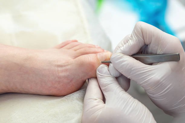 nail surgery for ingrown toenails