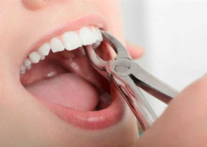 Tooth Extraction Uncovering Reasons for This Dental Procedure and the Process behind Tooth Extraction