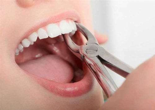 Tooth Extraction Uncovering Reasons for This Dental Procedure and the Process behind Tooth Extraction
