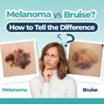 nail bruise vs melanoma