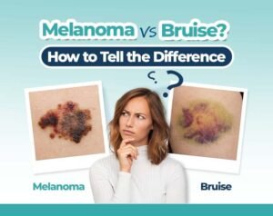nail bruise vs melanoma