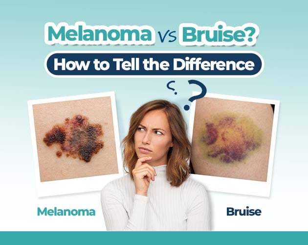 nail bruise vs melanoma