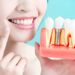 Renew Your Confidence with Professional Dental Implants in Cantonment, FL