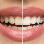 Enhance Your Smile with Laser Teeth Whitening in Dallas, TX