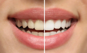 Enhance Your Smile with Laser Teeth Whitening in Dallas, TX