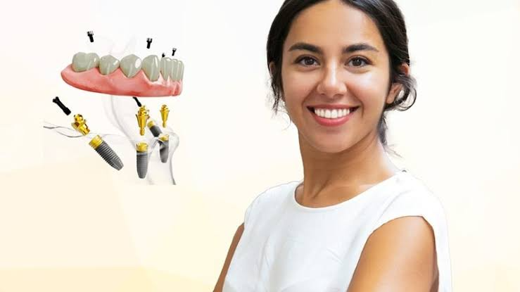 Restore Your Smile with Dental Implants in Pell City, AL