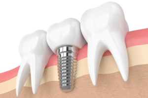 Natural Feel and Function of Teeth Achieved Through Dental Implants Say Goodbye to Gaps