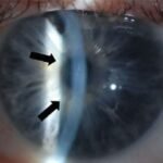 Eye Operation by Laser on Harley Street From £1,199 Per Eye Harley Vision