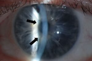 Eye Operation by Laser on Harley Street From £1,199 Per Eye Harley Vision