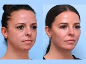 Best Plastic Surgeons in Dubai: Facial Through Non-Surgical Thread Lift