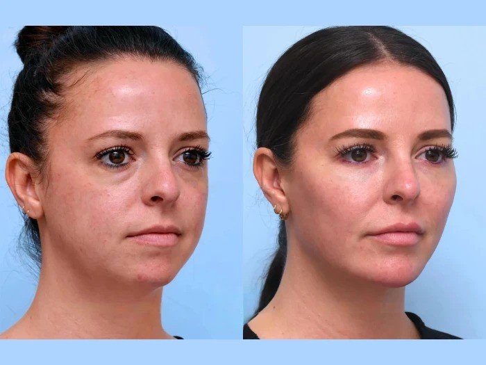 Best Plastic Surgeons in Dubai: Facial Through Non-Surgical Thread Lift