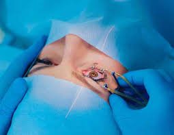 Eye surgeon performing laser vision correction surgery on a patient