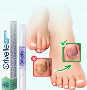 Orville for Toenail Fungus